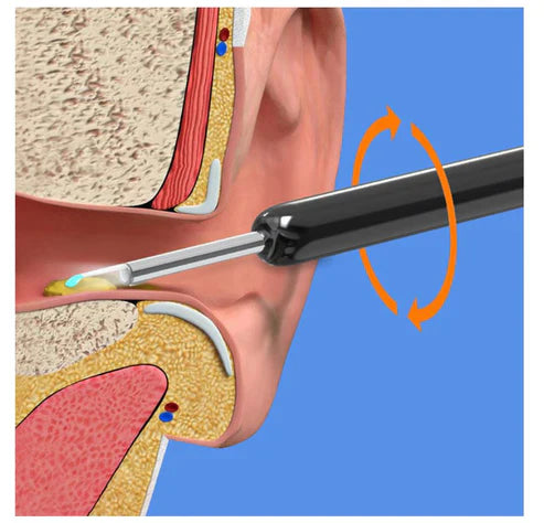 Earwax Removal Kit with Camera Clean Ears with Precision & Confidence