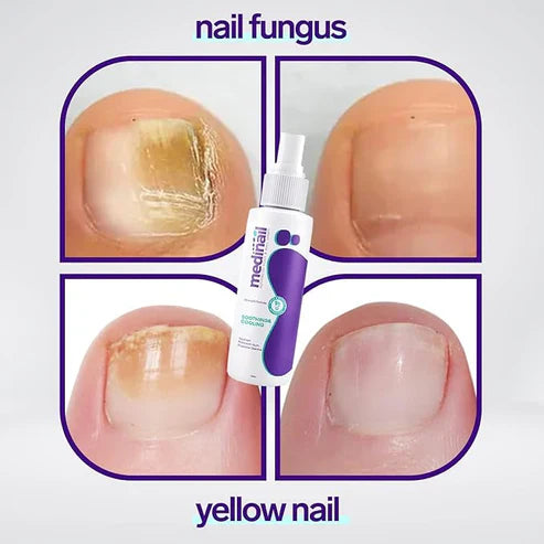Jaysuin Nail Fungus Spray Fast Relief & Healthier Nails in Days